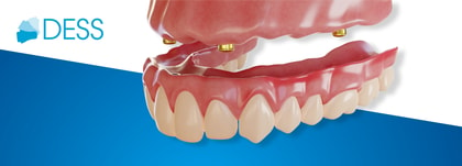 Benefits of Removable Overdentures: Clinical Insights & Patient Advantages