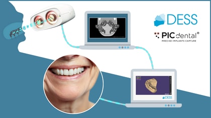 Maximale Präzision | Die Vorteile der Photogrammetrie bei Full Arch Implantatversorgungen