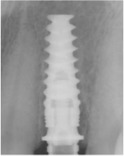 osteointegracion