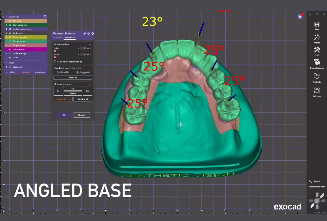 Digitaler CAD-Workflow für eine Implantatrestauration