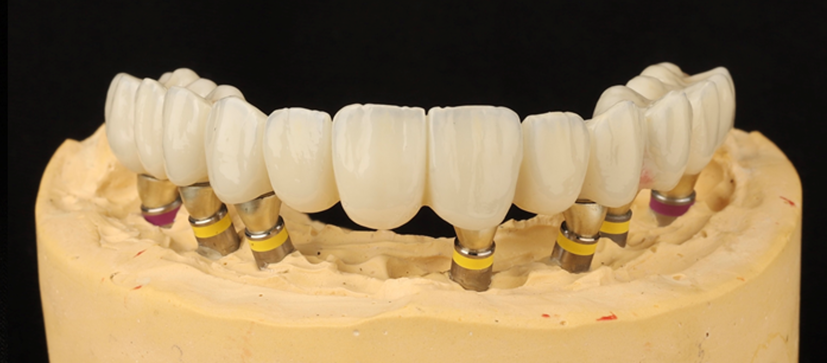 Full-Arch-Implantatrestauration von Kamal Jawabra