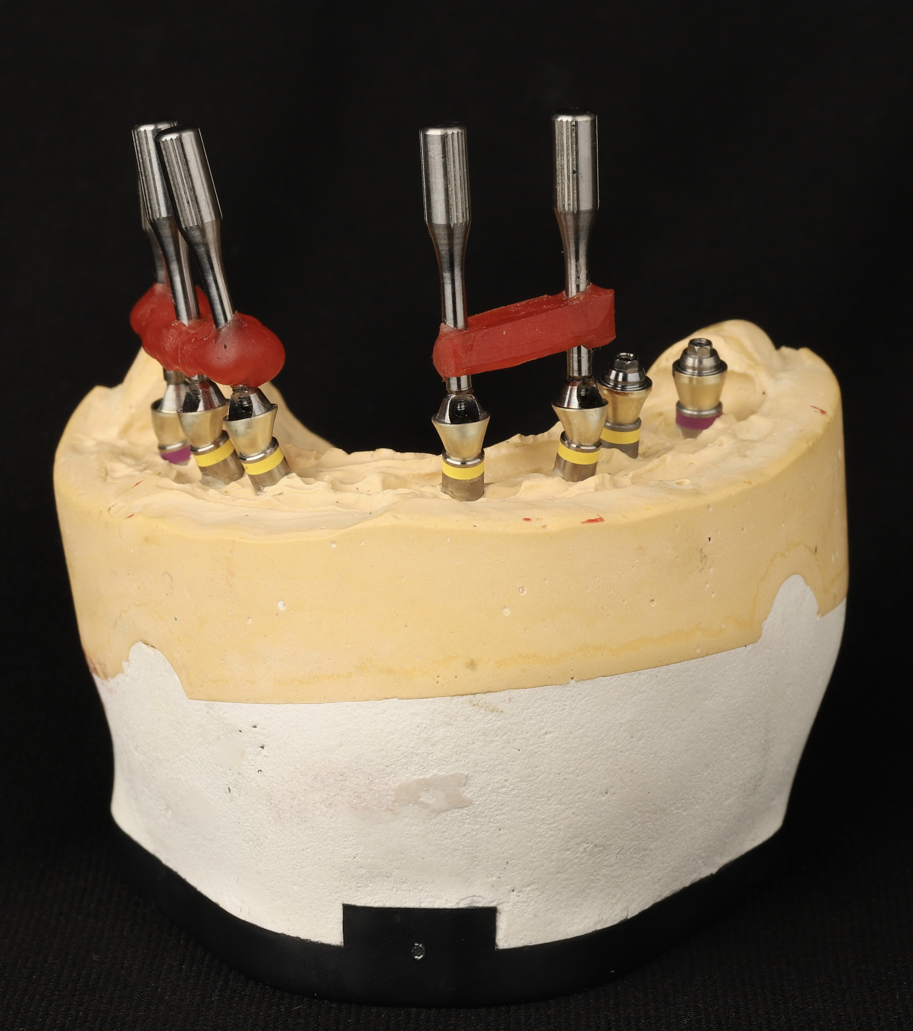 Implantatkomponenten für eine Full-Arch-Restauration