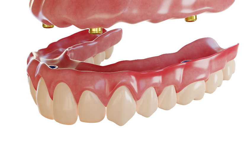 Implant-supported overdenture and its attachment components