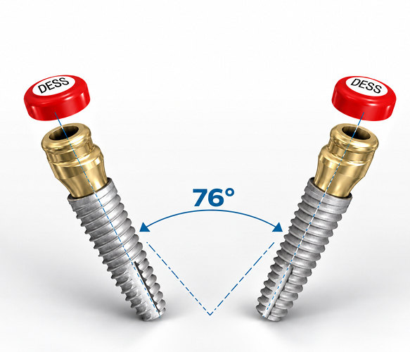 Illustration of 76° divergence between two implants with Angled DESSLoc®