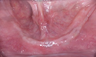 Initial clinical view before full-arch implant rehabilitation