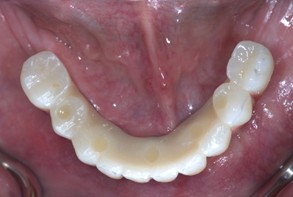 Intraoral occlusal view of the maxilla before implant-supported rehabilitation