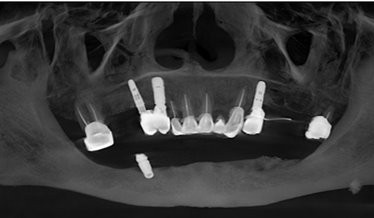 Radiographic planning for maxillary rehabilitation with DESS® implants