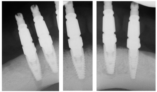 Radiographic verification of implants for an implant-supported fixed prosthesis