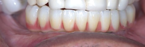 Final full-arch screw-retained fixed prosthesis on implants