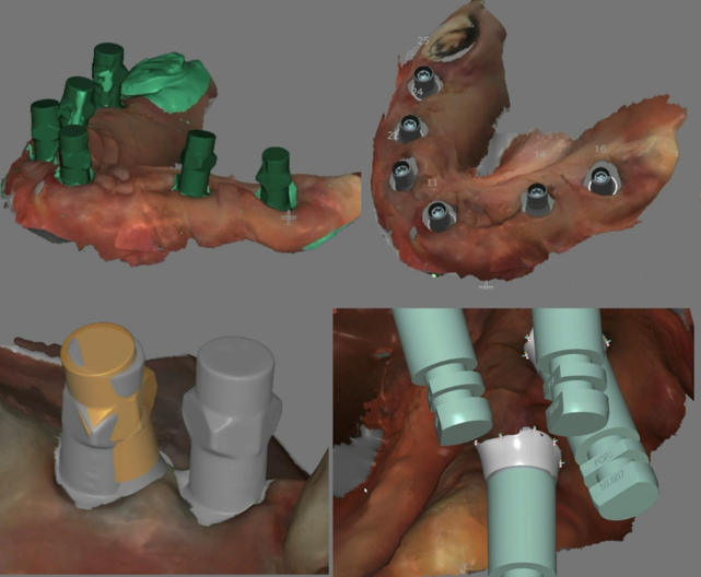 Verificación del asentamiento del scanbody en un flujo digital sobre implantes