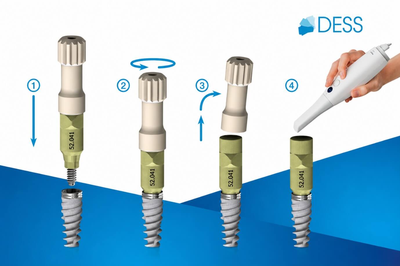 DESS® scan body placement and scanning workflow on a dental implant