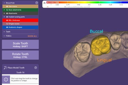 CAD software interface showing scan body library matching in a digital implant workflow