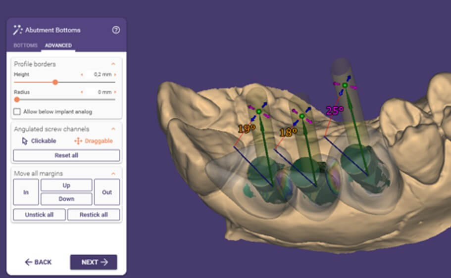 CAD implant restoration design with angulated screw channel planning