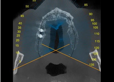 Digital planning view for implant treatment predictability