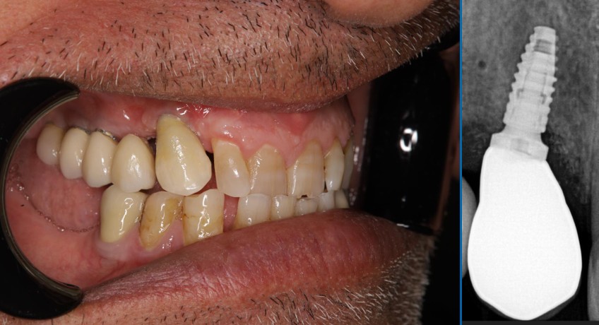 Clinical situation used for implant planning and guided workflow assessment