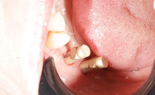 Intraoral clinical view during implant workflow planning