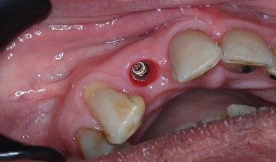 Clinical implant case showing prosthetic planning and precision in implant dentistry