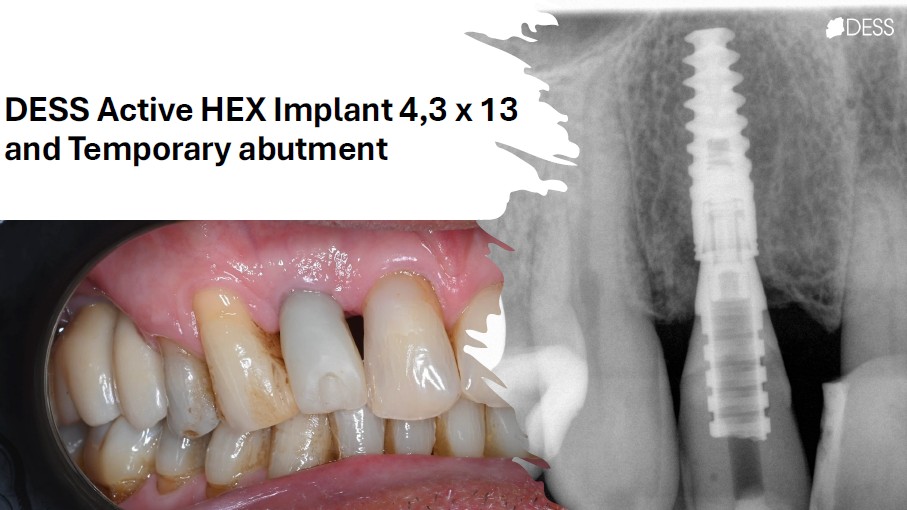 Radiographic and clinical view from an implant treatment workflow by Dr. Mats Christiansen