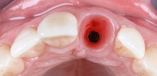 Peri-implant soft tissue around a dental implant in an occlusal clinical view