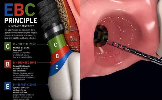 Esthetic Biological Contour concept showing emergence profile zones around an implant