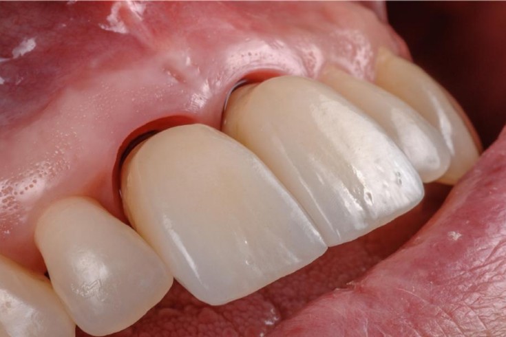 Implant restoration emergence profile and peri-implant soft tissue integration