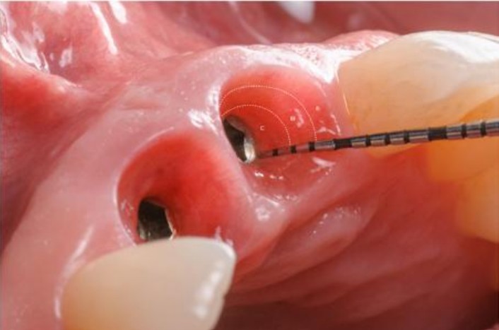 Clinical measurement of peri-implant soft tissue for restorative planning