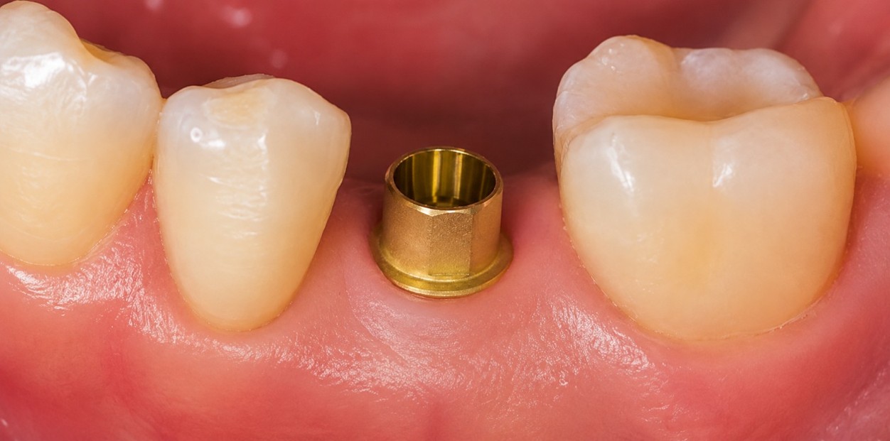 Thinner ANGLEBase® positioned in a narrow mesio-distal restorative space