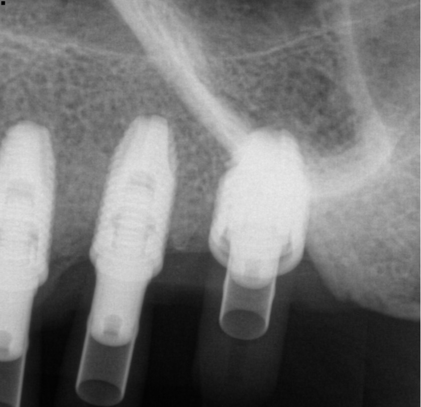 X-ray PEEK scan abutment