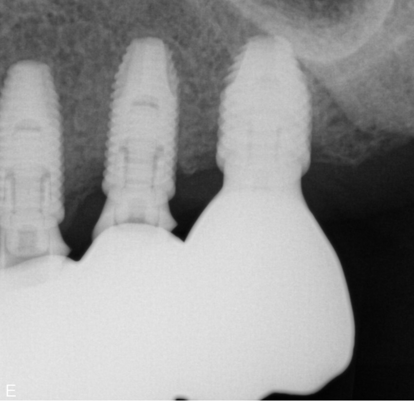 crown on peek scan abutment